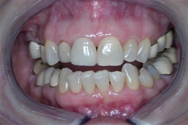 healthy gums alternative periodontal disease treatment Kentucky, Shepherdsville, Louisville